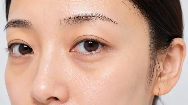 Thermage Eye 450高能量眼部療程前參考圖